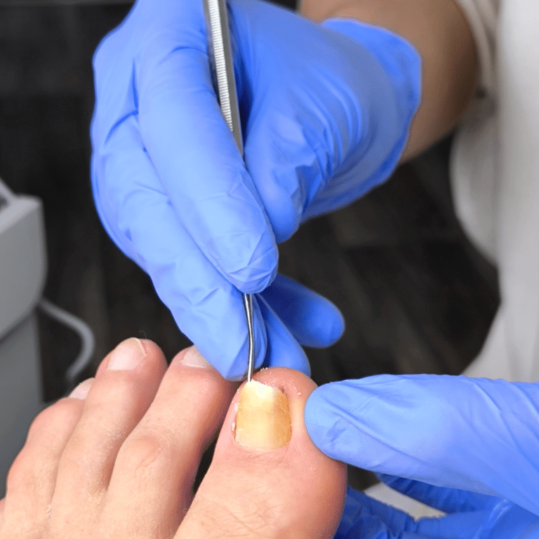 Toenail Removal